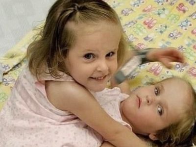 These Siamese Twins were Separated when They were 4 Years old: How are They Doing Now?