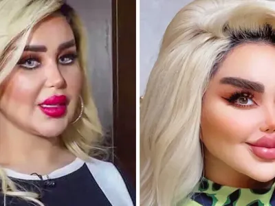 Incredible Transformation: Woman Undergoes 43 Plastic Surgeries!