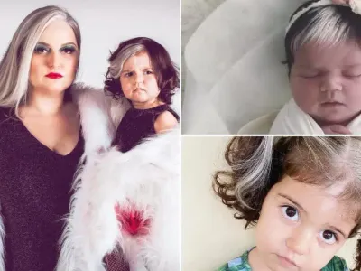 Unique Girl with White Streak Hair Captures Hearts Worldwide