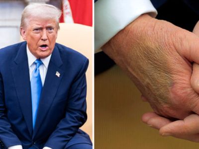 White House responds after Donald Trump sports nasty bruise